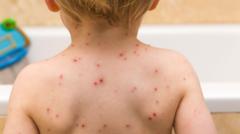 children-to-be-offered-chickenpox-vaccine-on-nhs